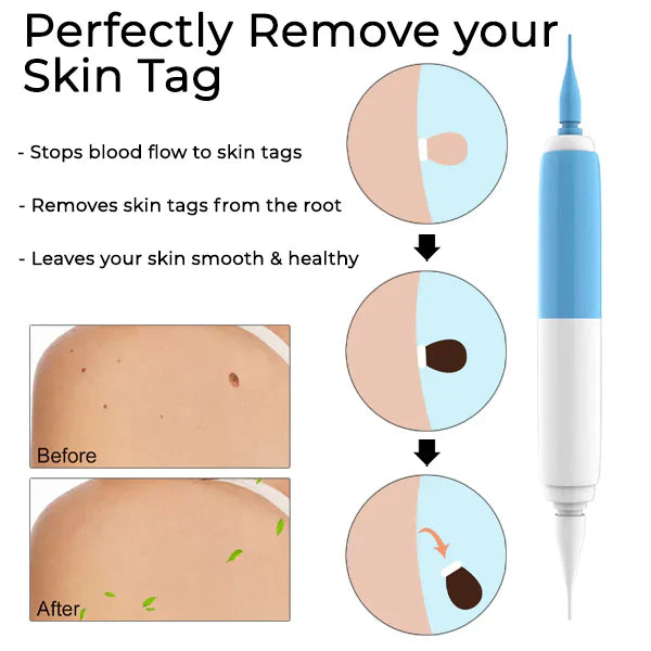 GlowAway™ — Painlessly Banish Skin Tags in Just Days!